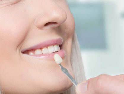Todo lo que necesitas saber sobre carillas dentales